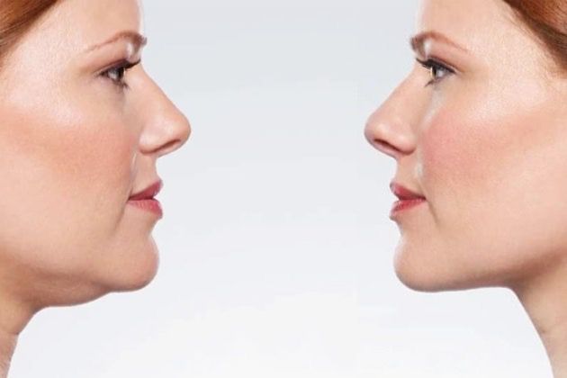 5 Simple exercises to get rid of double chin
