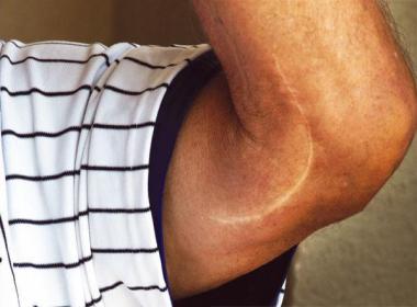 WHAT IS TOMMY JOHN SURGERY
