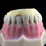 Acrylic Denture Teeth Solutions in Calgary Alberta Dentures