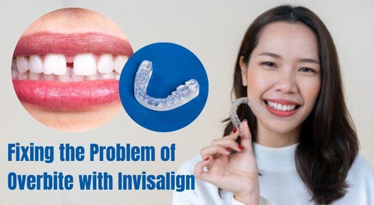 How Can Invisalign Treatment Fix the Problem of Overbite