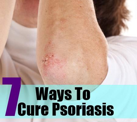 Home Remedies For Psoriasis