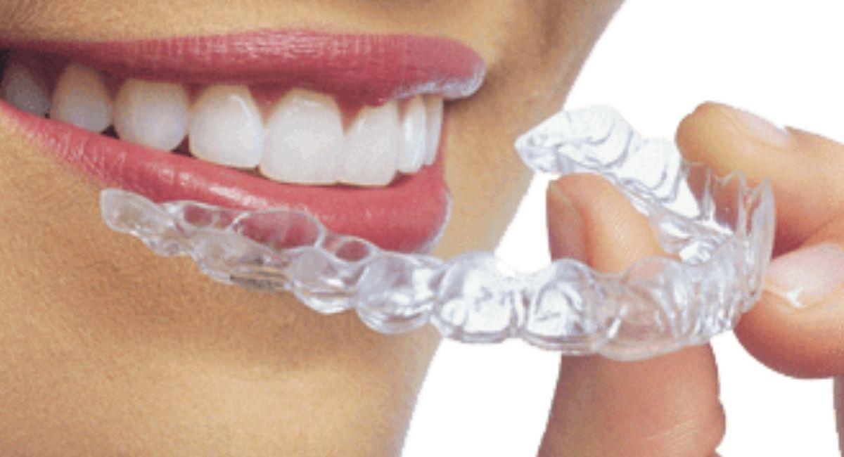 The Invisalign Everything you need to know