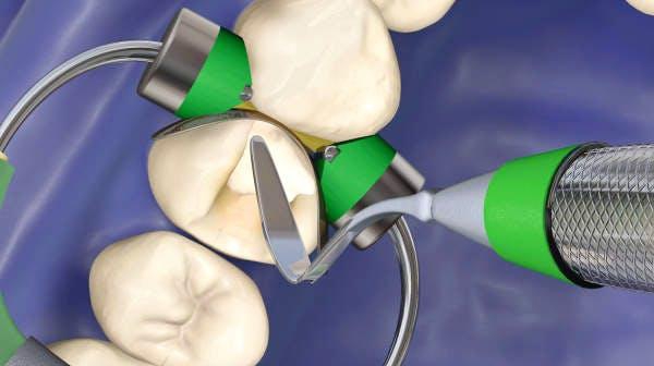 Dental Biomaterials of Dental Consumables Market With Impact of COVID 19 Top Companies Emerging Trends
