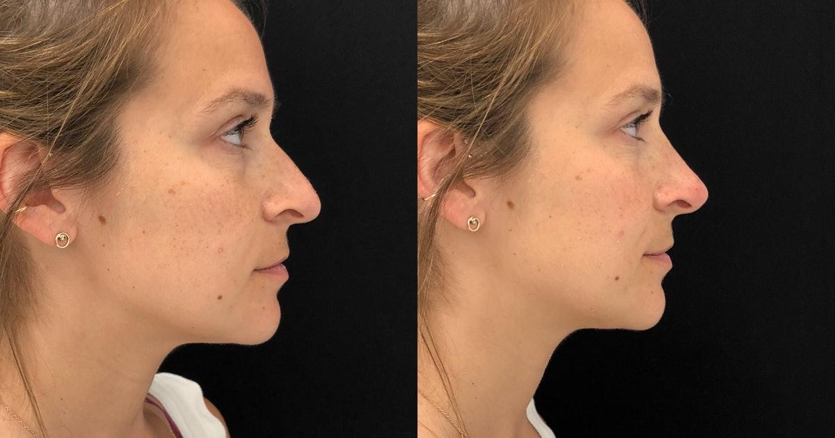 All About Non Surgical Rhinoplasty