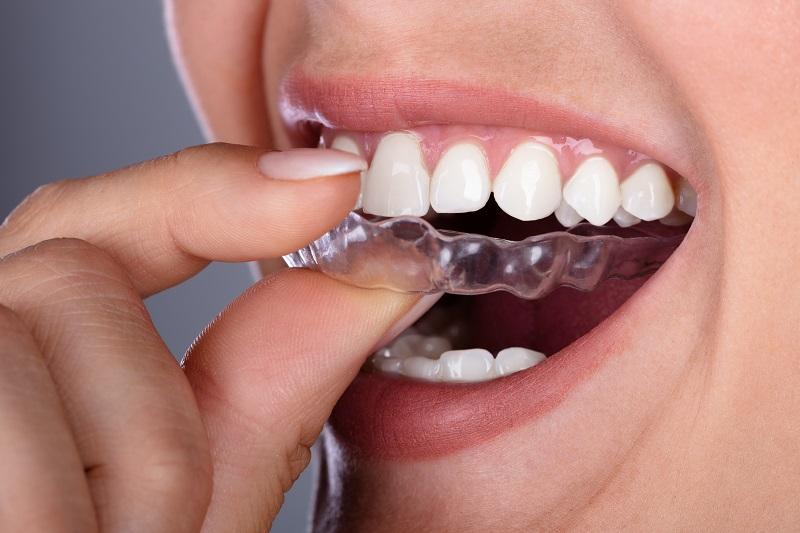 All About Orthodontics The History of Braces and Clear Aligners